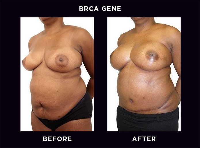 BRCA Gene