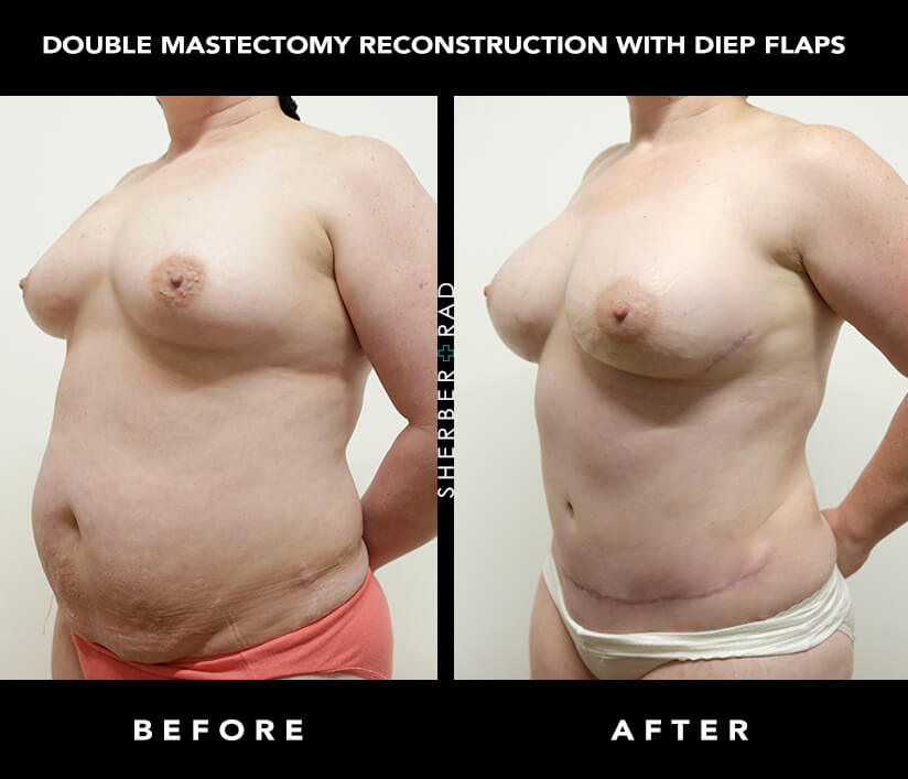 DIEP Flap Breast Reconstruction in Washington, DC - Breast
