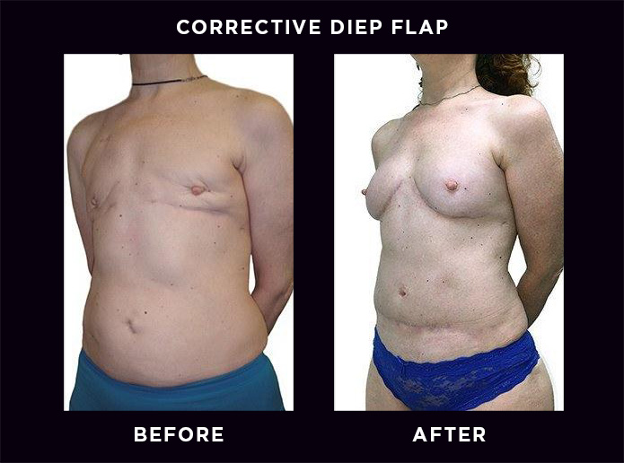 DIEP Flap Breast Reconstruction in Washington, DC - Breast