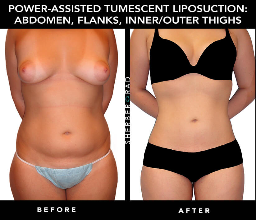 How UCHD Liposuction Is Redefining Body Contouring - Plastic