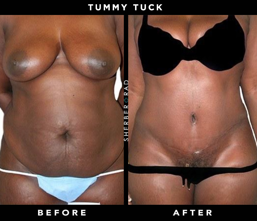Washington, DC Residents Ask: Will I Need to Buy New Clothes After a Tummy  Tuck and Liposuction? - Younger Image Plastic Surgery Center