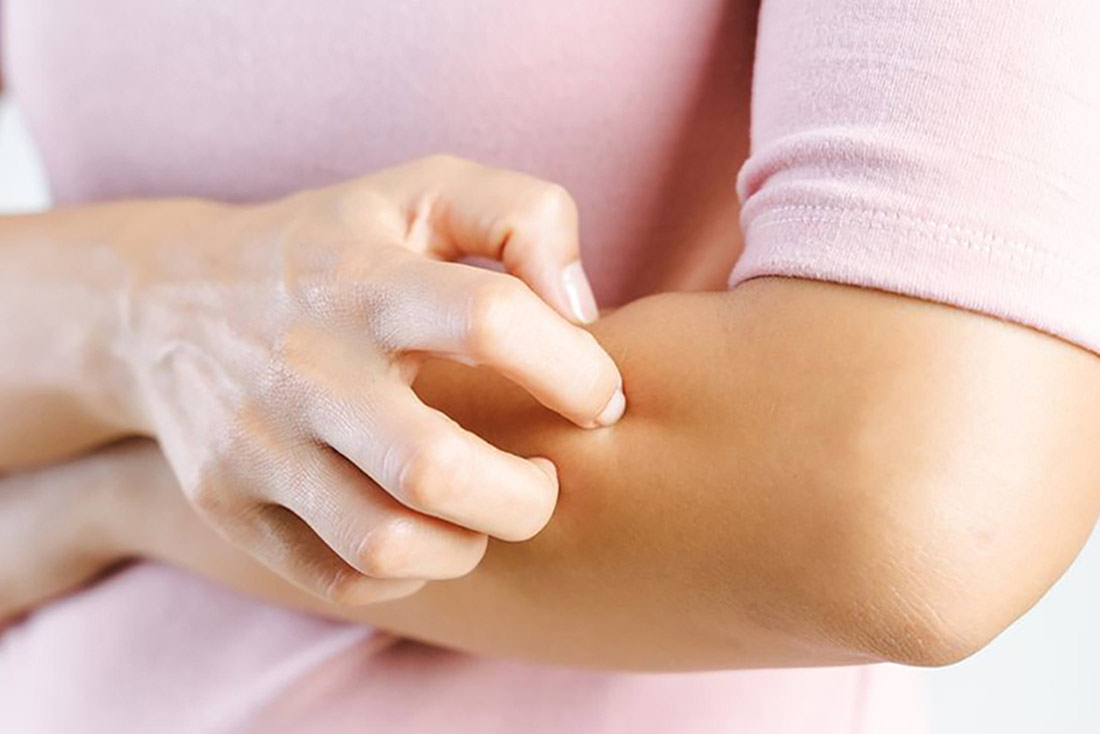 Woman scratching itchy psoriasis on her arm