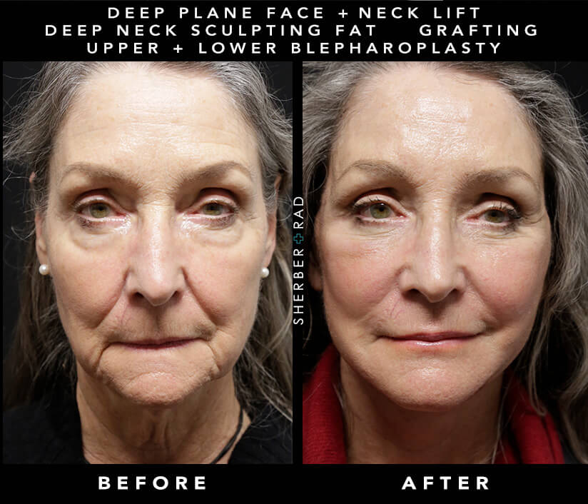 Deep Plane Face/Neck Lift Before and After Results