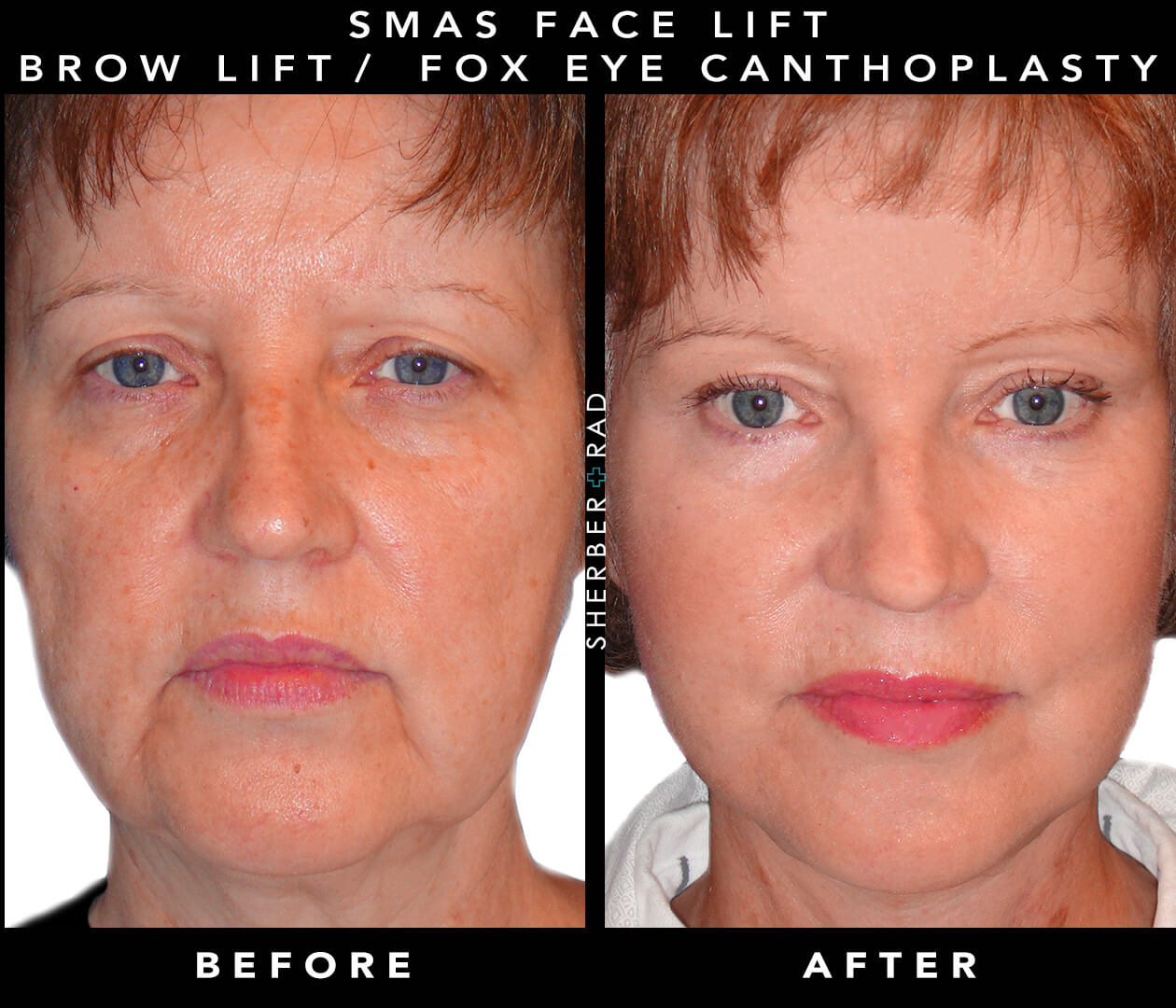SMAS Plication Face/Neck Lift Before and After Results"
