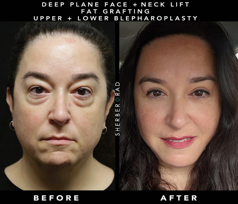 Learn Fundamental Beauty & Face Contouring Technique Non-Surgical Facelift  Using 4 Core Concepts 