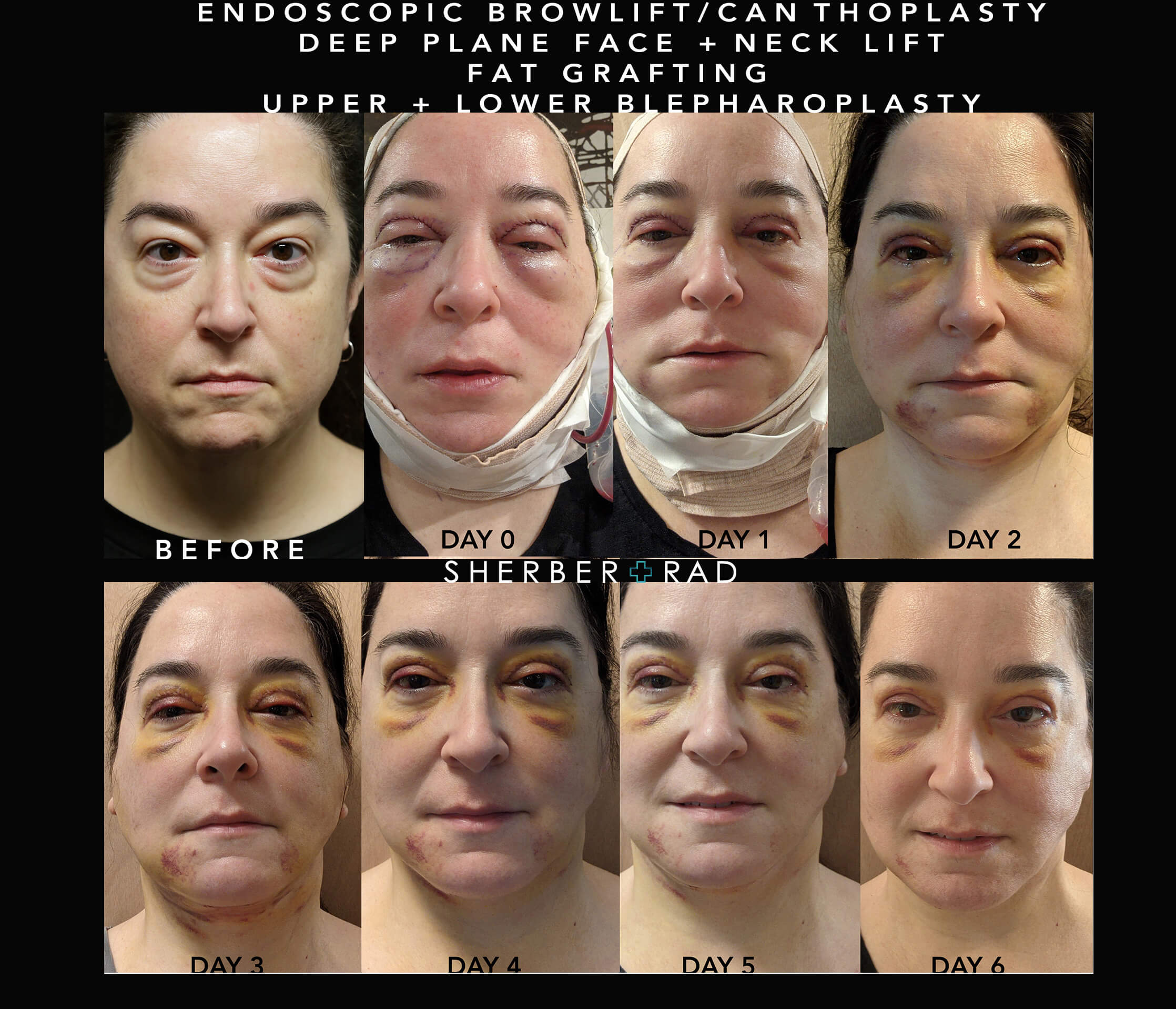 Facelift Post-Procedure Recovery | Sherber+Rad