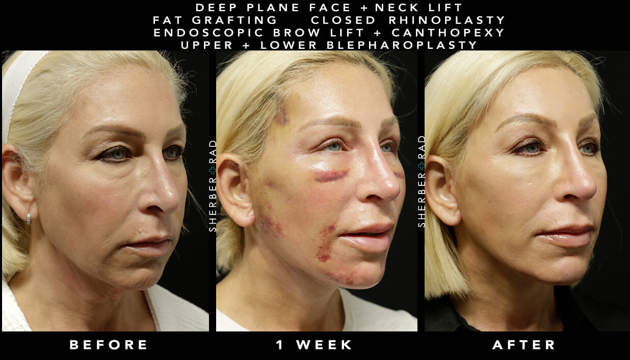 Facelift Post-Procedure Recovery | Sherber+Rad