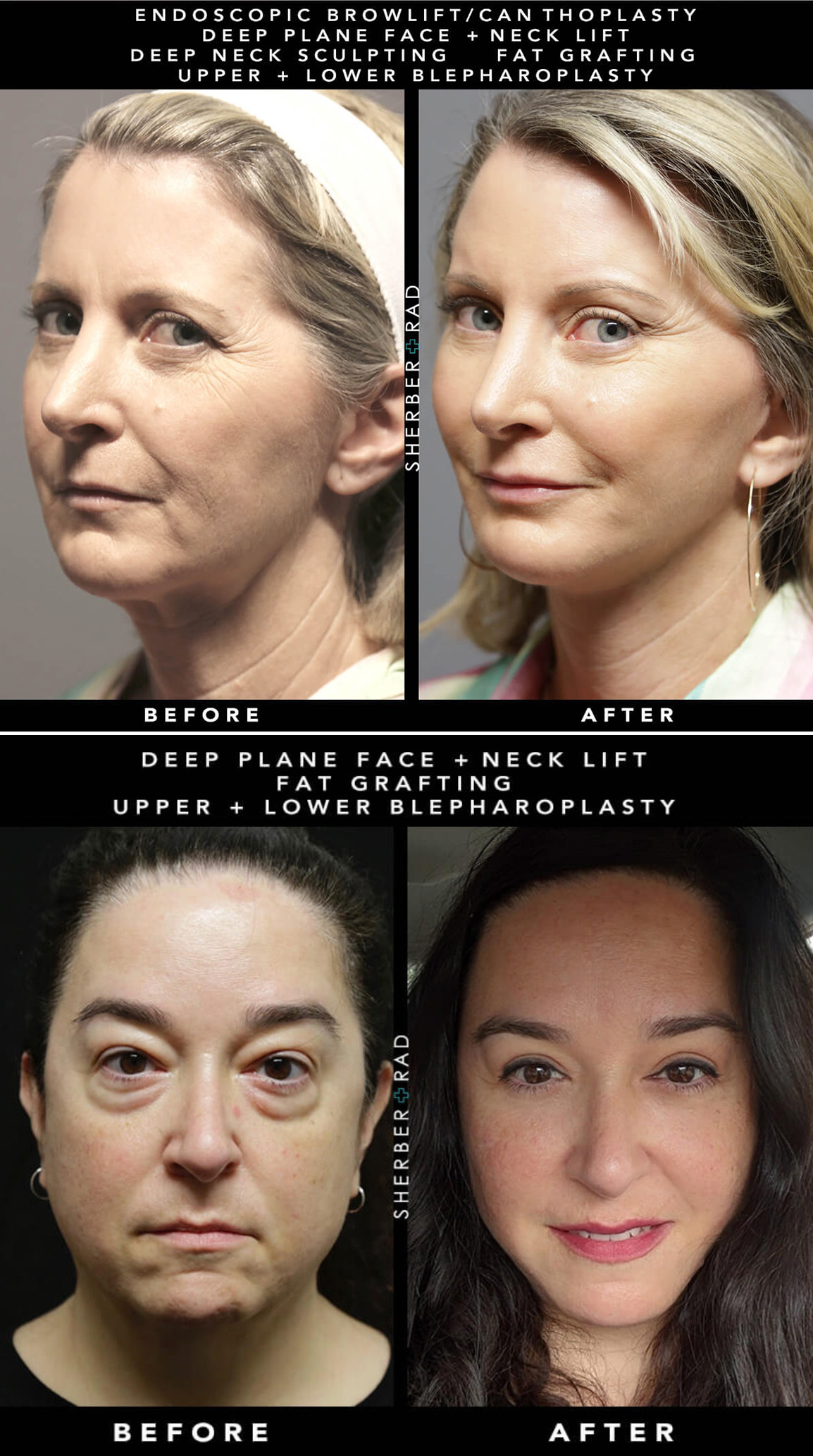 How to look younger: 60-year-old transforms jowls with filler