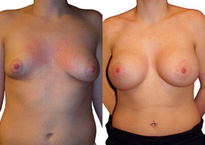 Breast Augmentation before and after photos by Sherber and Rad in Washington, DC