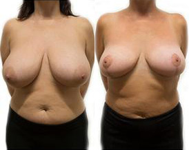 Breast Lift + Reduction before and after photos by Sherber and Rad in Washington, DC