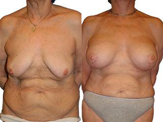 Breast Augmentation before and after photos by Sherber and Rad in Washington, DC