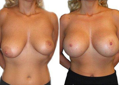 Breast Lift + Reduction before and after photos by Sherber and Rad in Washington, DC