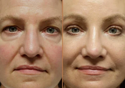 Rhinoplasty before and after photos by Sherber and Rad in Washington, DC