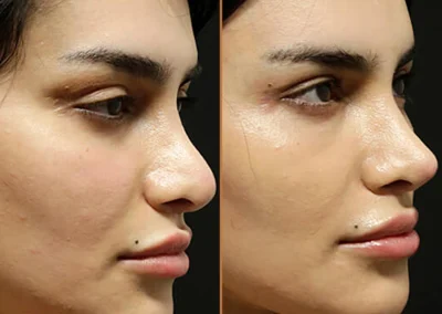 Rhinoplasty before and after photos by Sherber and Rad in Washington, DC