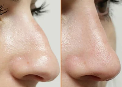 Rhinoplasty before and after photos by Sherber and Rad in Washington, DC