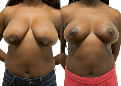 Breast Lift + Reduction before and after photos by Sherber and Rad in Washington, DC