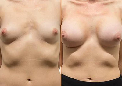 Breast Augmentation before and after photos by Sherber and Rad in Washington, DC