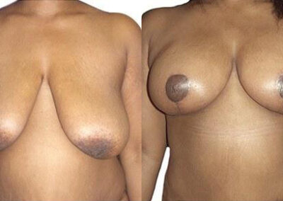 Breast Lift + Reduction before and after photos by Sherber and Rad in Washington, DC