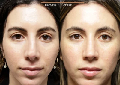 Rhinoplasty before and after photos by Sherber and Rad in Washington, DC