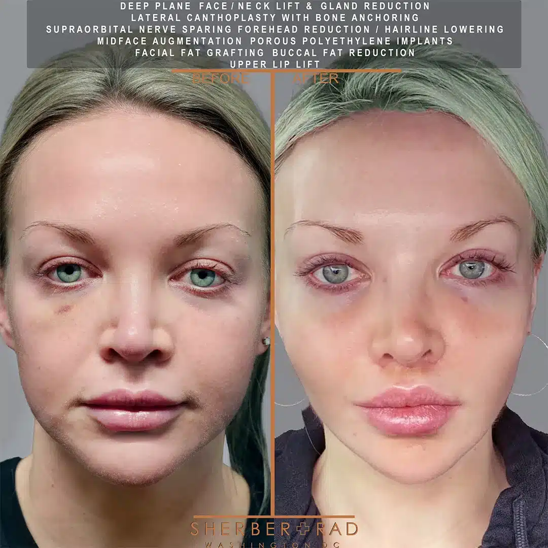 Facial Optimization before and after photos by Sherber and Rad in Washington DC