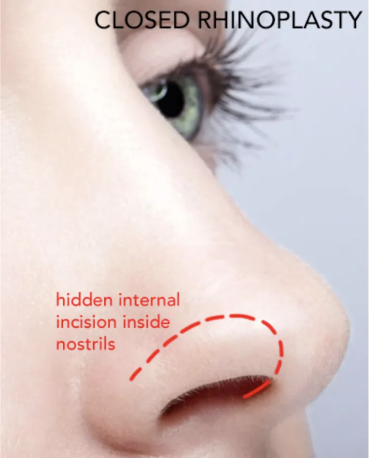 Graphical illustration of closed rhinoplasty procedure on the nose