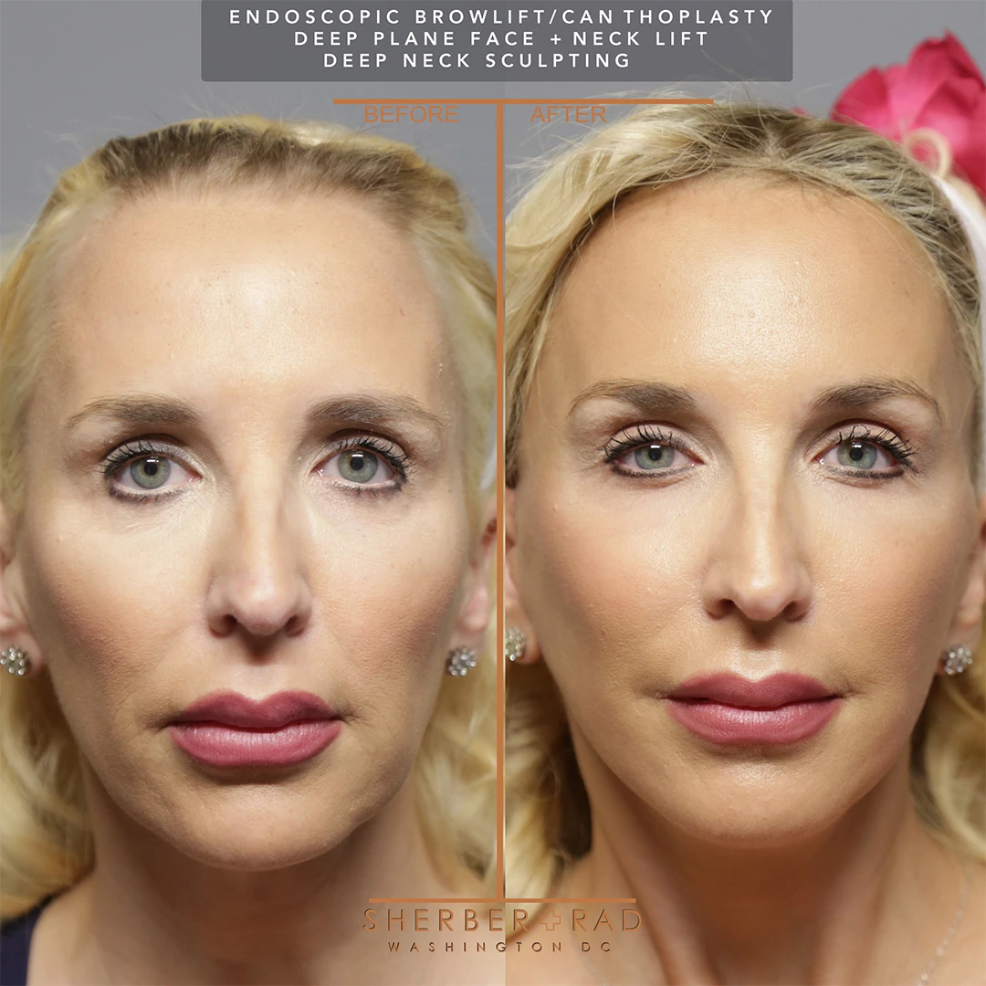 short scar facelift before and after results