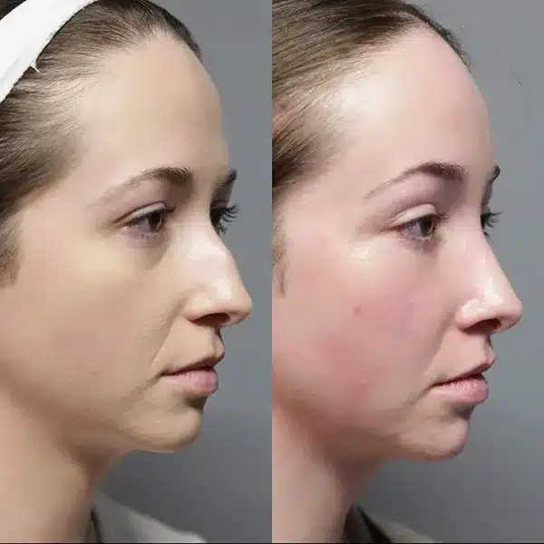 closed rhinoplasty before and after