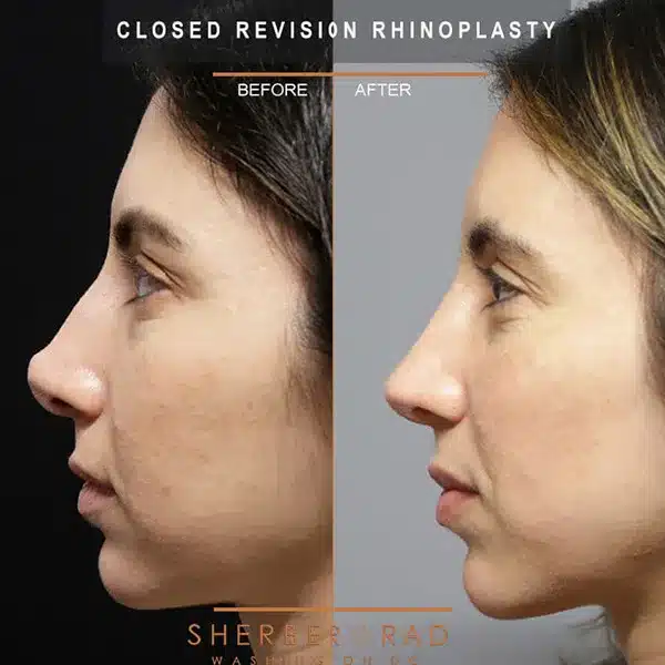 revision rhinoplasty before and after photos by sherber and rad in washington dc